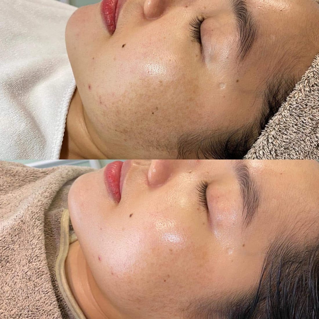 Kết quả trước và sau tại Her S Spa Saigon