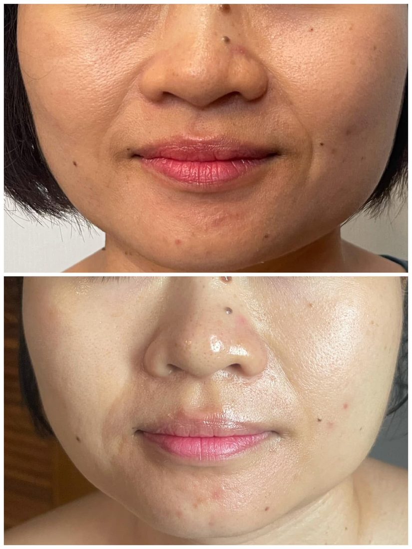 Kết quả trước và sau tại Her S Spa Saigon