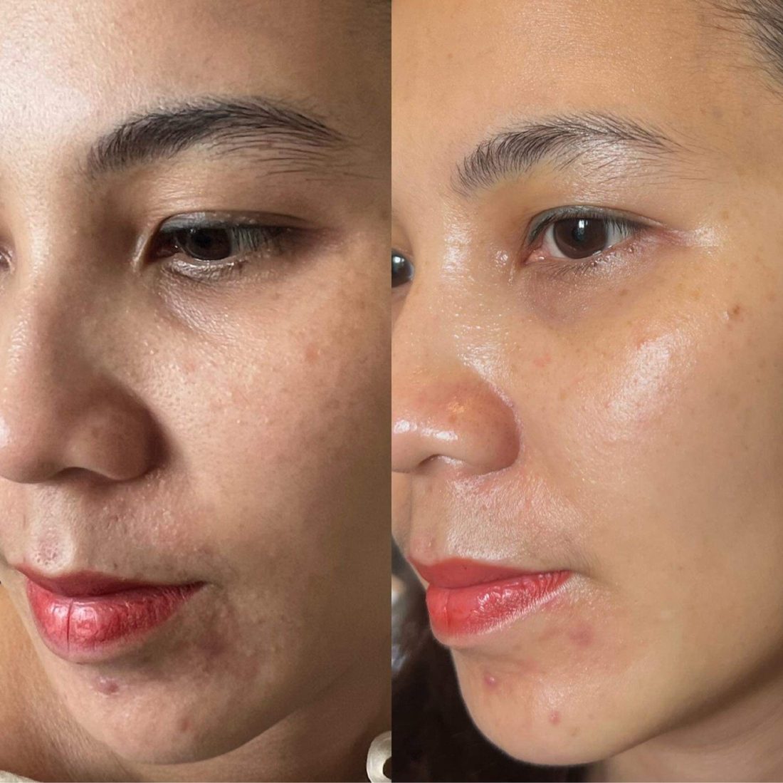 Kết quả trước và sau tại Her S Spa Saigon