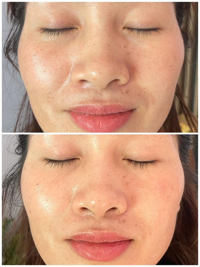 Kết quả trước và sau tại Her S Spa Saigon