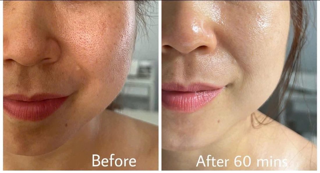 Kết quả trước và sau tại Her S Spa Saigon